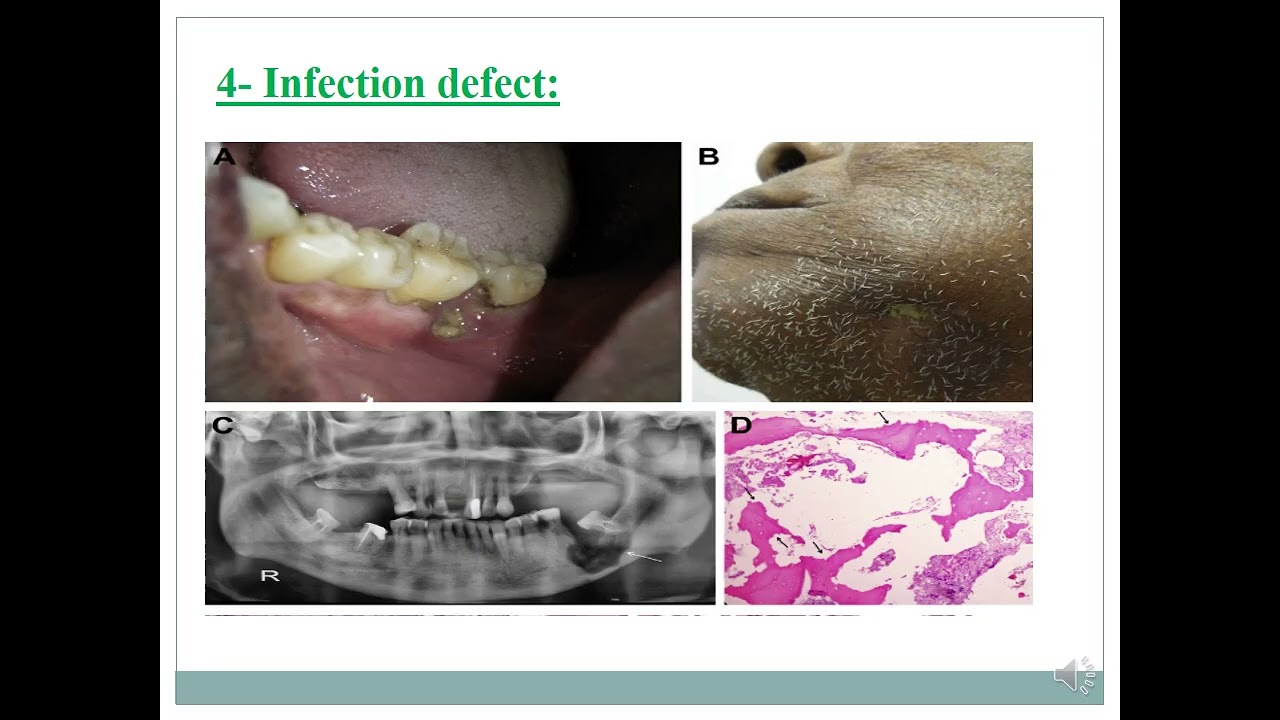 Techniques for Ridge Preservation and Augmentation in Oral Implantology . Dr Mohammed Alquhaif