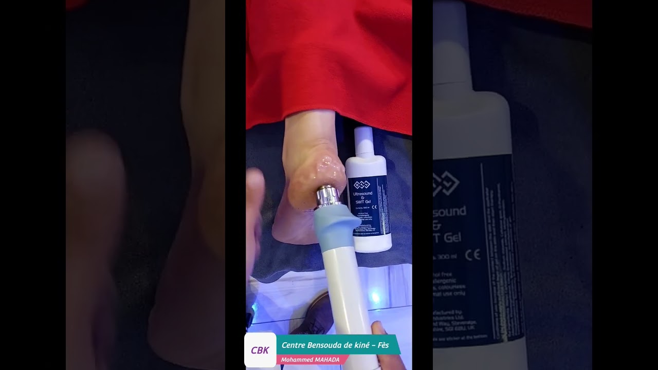 علاج الشوكة العظمية باستخدام الموجات التصادمية.