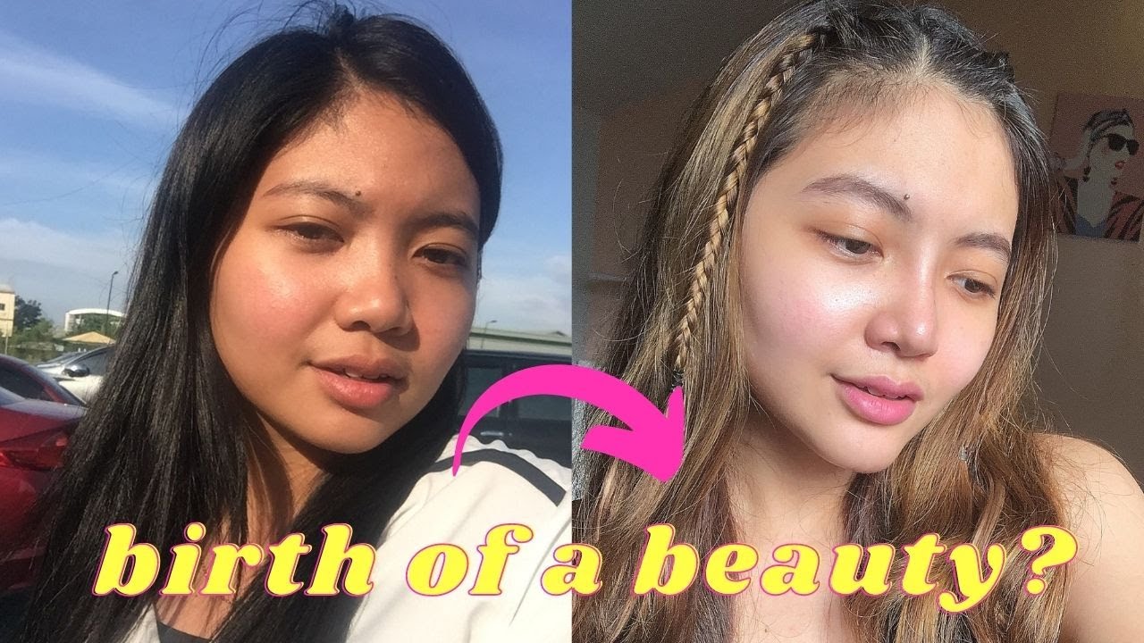 RHINOPLASTY, CHIN AUGMENTATION AND BUCCAL FAT REMOVAL BY DOC MARLON LAJO | ALEX BALTAZAR