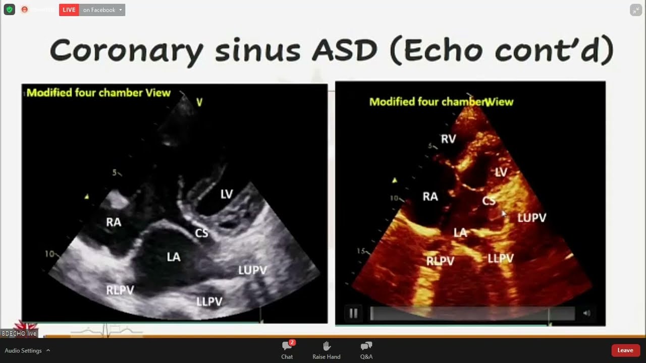 ASD (Coronary Sinus type)