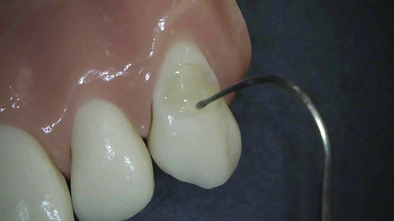 Dr. Robert Marus Demos G-ænial™ Universal Injectable & everX Flow™