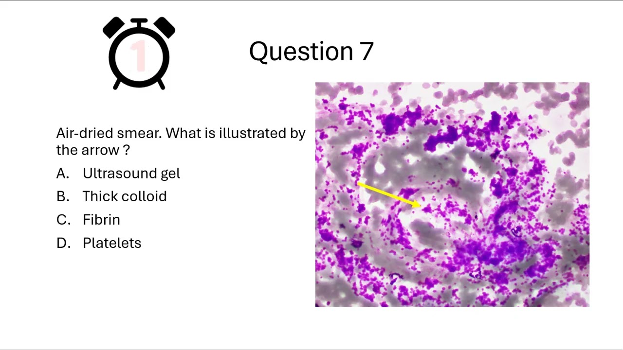 Pathweb Cytopathology Quiz: Thyroid Cytology 2.1 INTERMEDIATE level