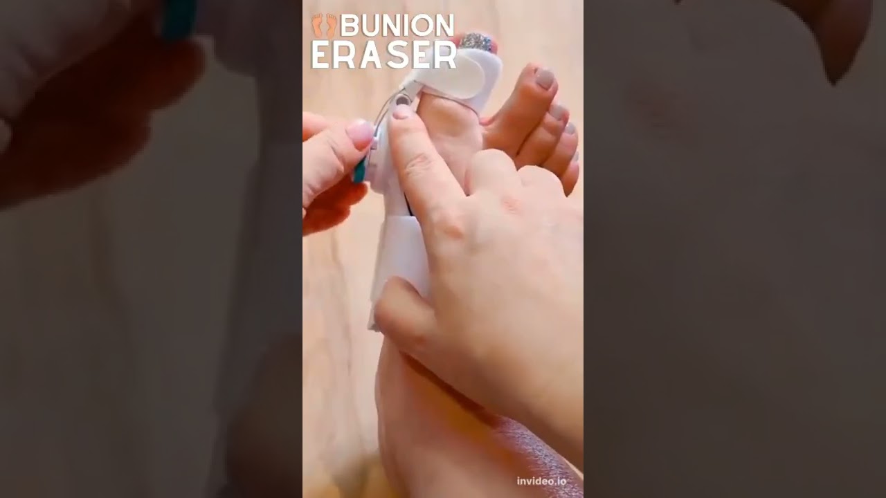 Bunion Eraser Toe Corrector #happy #health #pain #viral #youtubeshorts