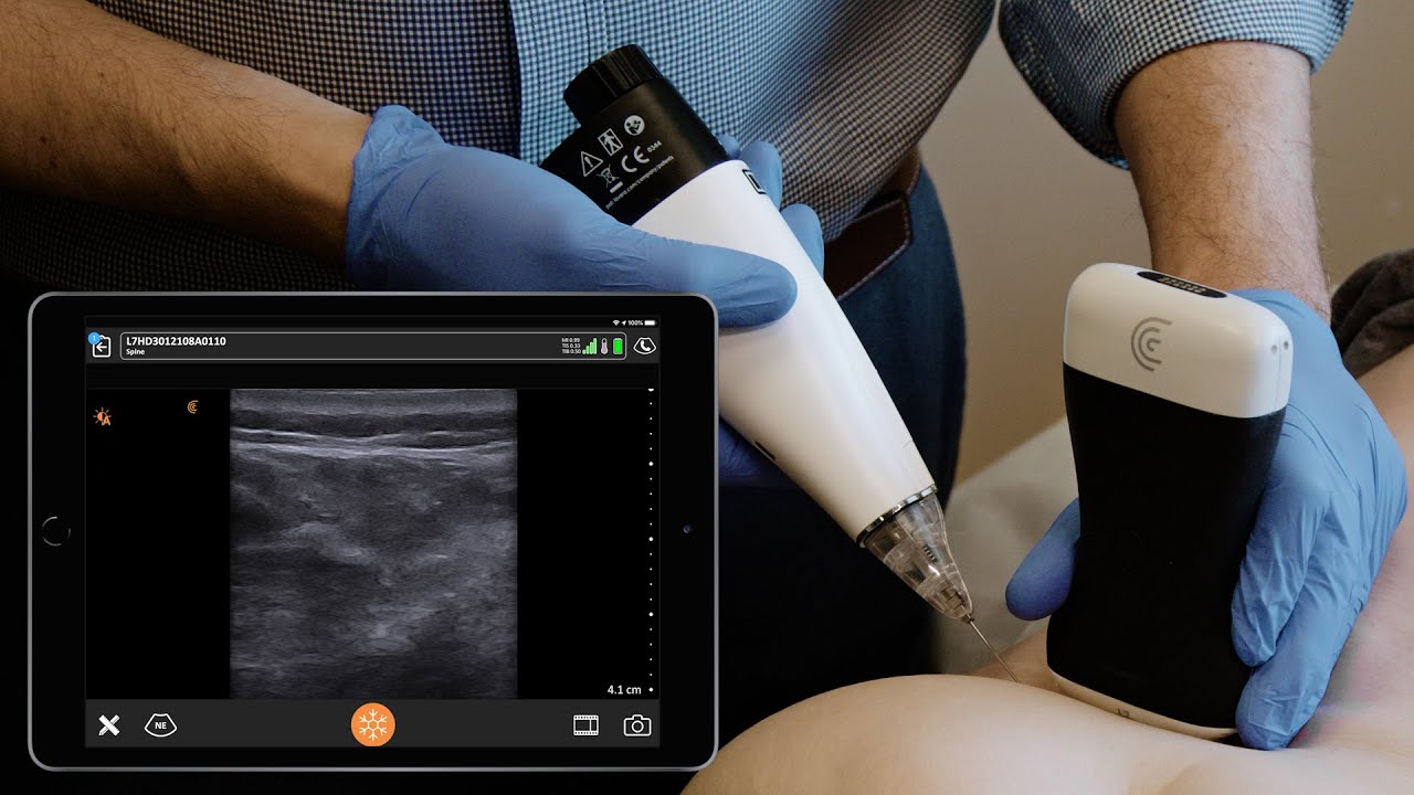 Блокада ягодичного нерва