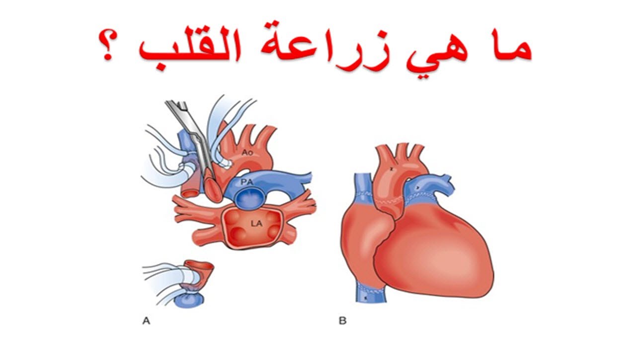 ما هي زراعة القلب ؟ متى يتم اللجوء لزراعة القلب ؟ من المرضى الذين يصلحوا لزراعة القلب ؟ من لا يصلح ؟