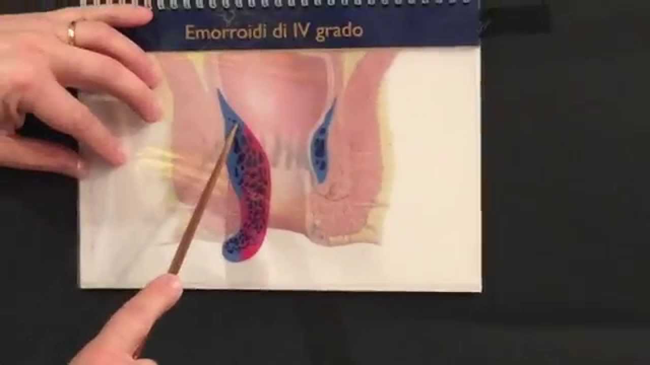Emorroidi - Cosa sono