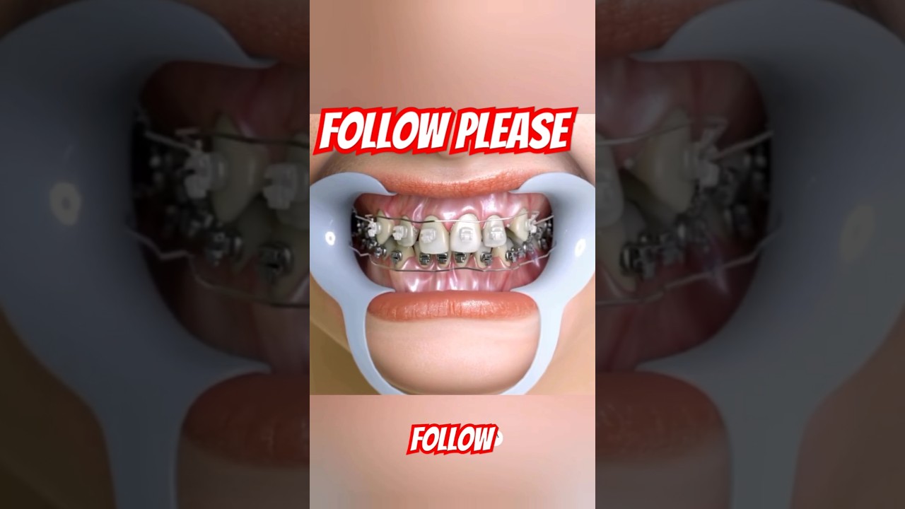 😱waauu 😱 ortodoncia #dantis #orthodontist #shortvideo