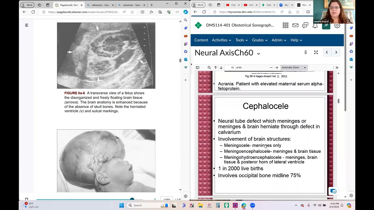 DMS 114 Ch 60 Fetal Neural Axis