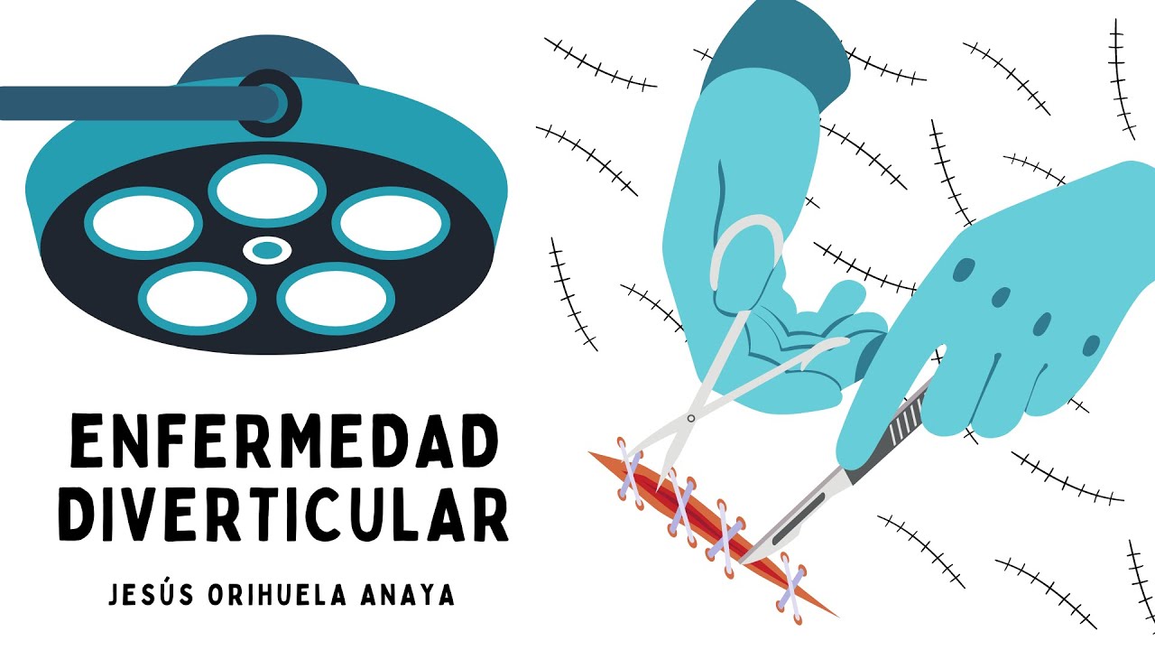 Enfermedad diverticular