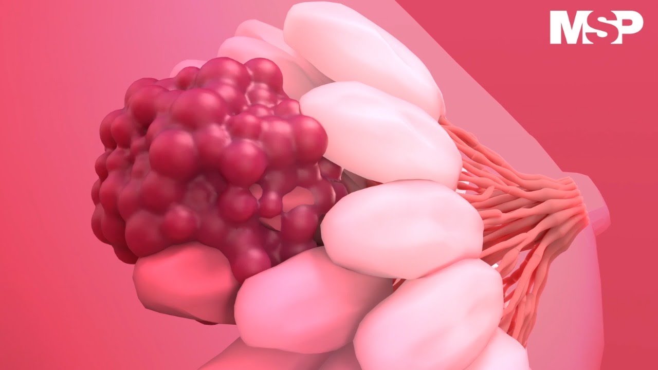 Cáncer de mama