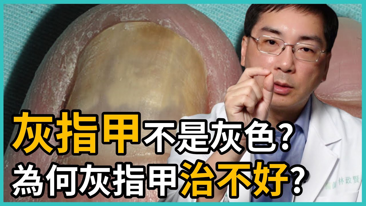 灰指甲不是灰色的嗎？還有其他顏色嗎？為何灰指甲一直治不好？讓皮膚科林政賢醫師一一點破治療灰指甲的NG行為吧！