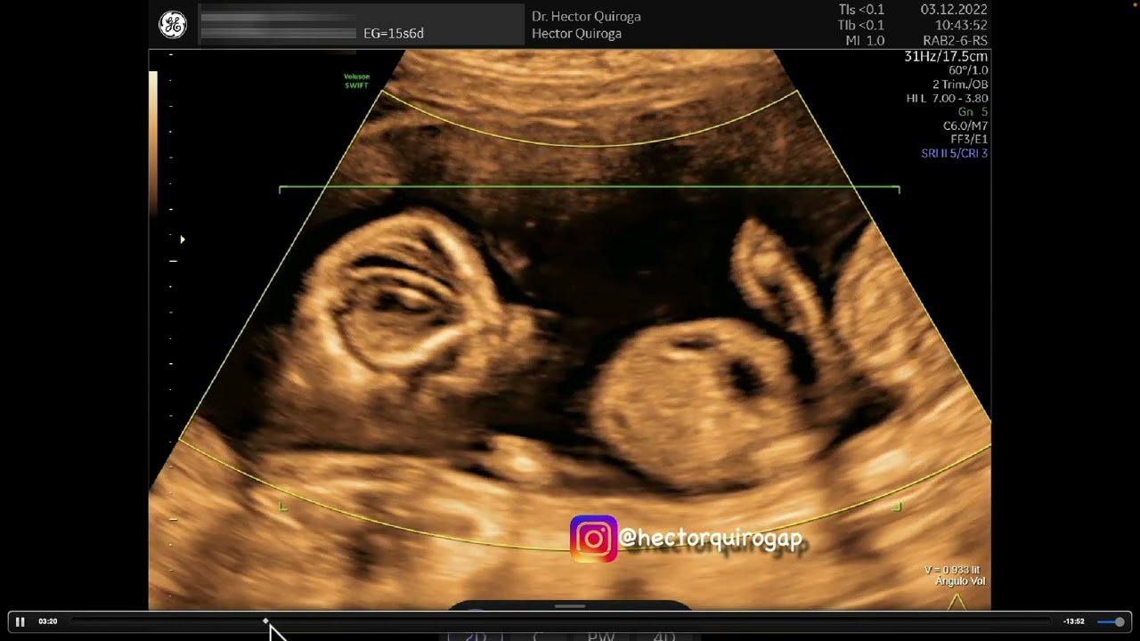 Ultrasonido en Medicina Fetal: Síndrome de Transfusión Feto  -  Fetal