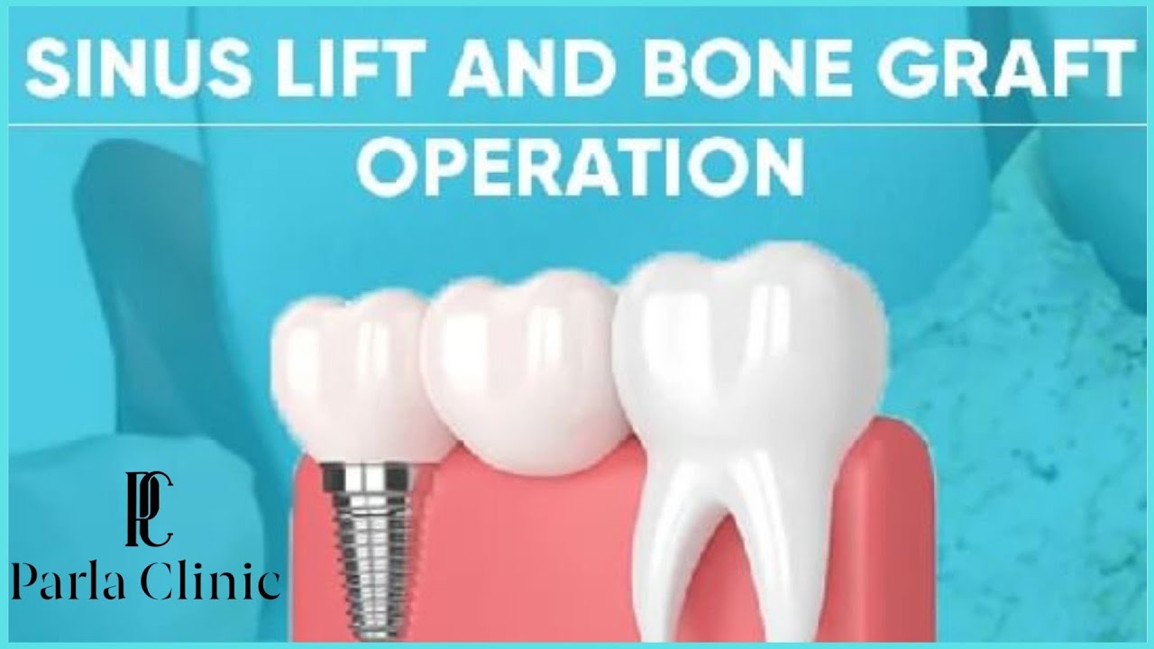 Sinus lift and bone graft operation