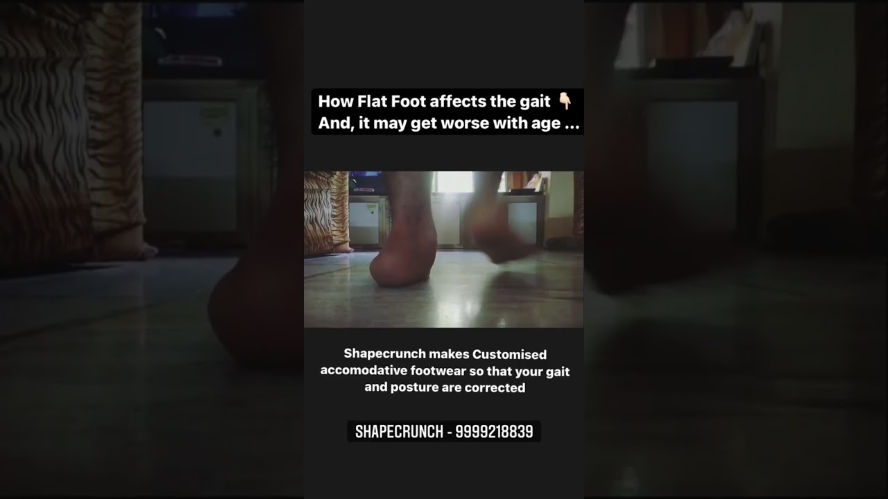 How Flat Feet affects your gait and Posture ?