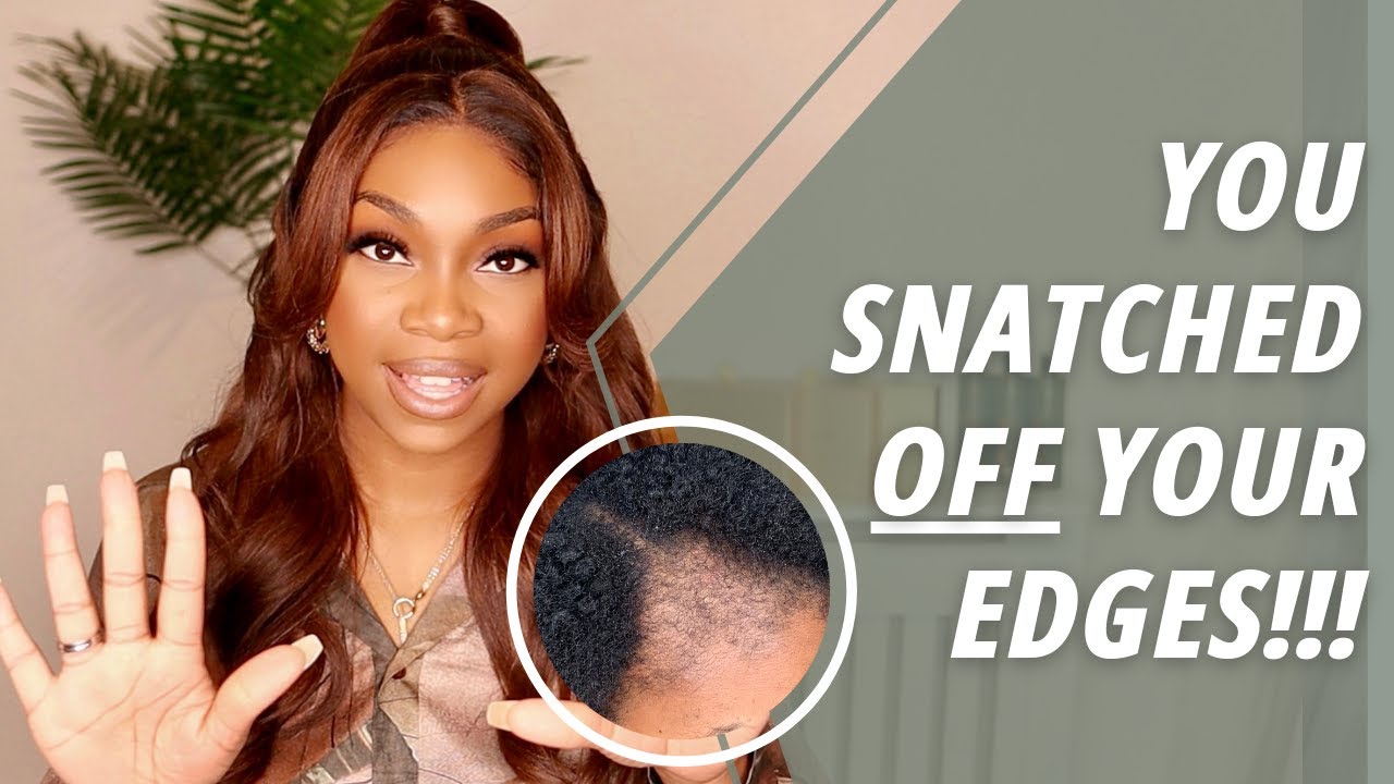 Top 10 Tips to AVOID HAIR LOSS when wearing WIGS | This Is Why Your EDGES Are DISAPPEARING!