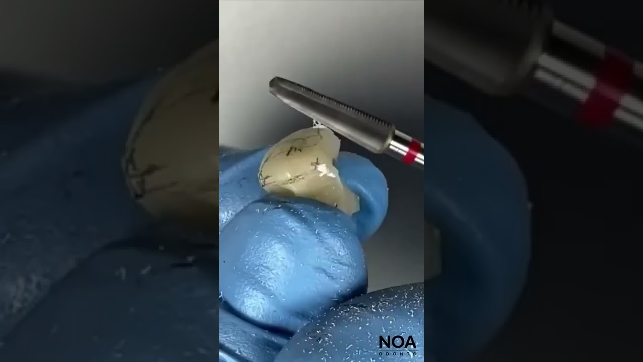 DIENTE PROVISORIO DE ACRÍLICO 😲 