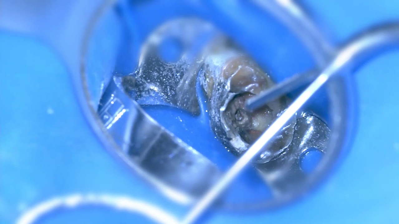 Removal of long broken file.. Dr. Ala'a Younis (  ازاله اداه مكسوره من القناه الدكتور علاء يونس)
