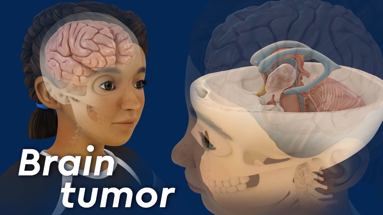 What is Craniopharyngioma?