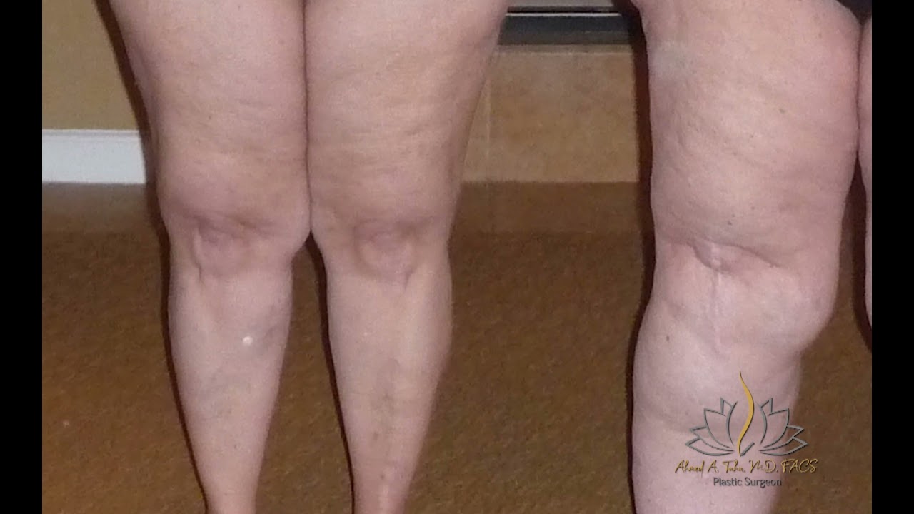 Lipedema, What you need to know; Episode 1