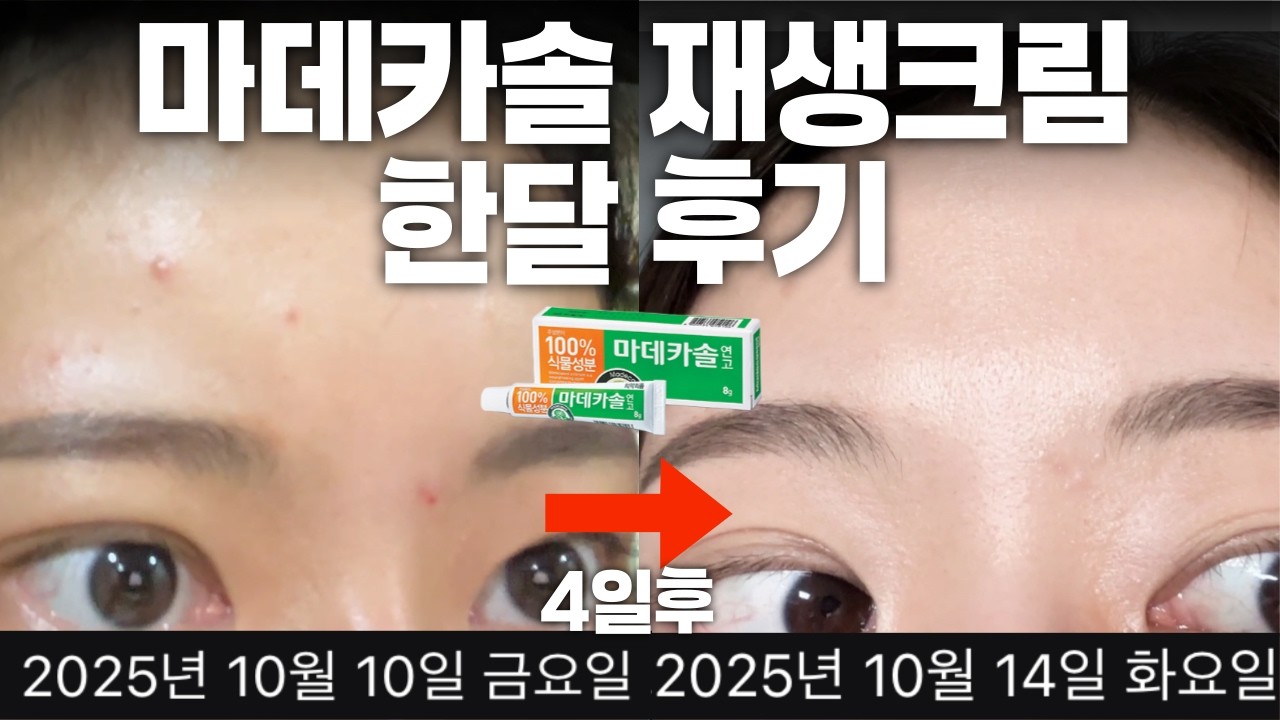 제발 '비싼 재생크림' 쓰지마세요.. 마데카솔 재생크림으로 4일만에 깐달걀피부 되는법ㅣ모낭염, 여드름 흉터 없애는법, 압출, 시술 후 재생크림
