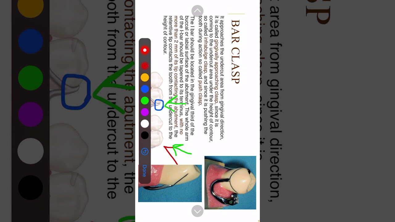 3-12 Prosthodontics, Types of clasp assemblies (2).