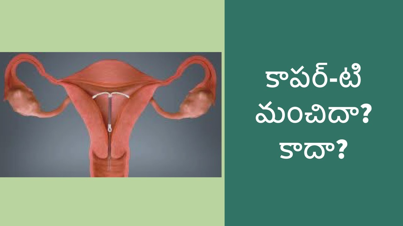 All about Copper T || family planning method||best gynaecologist in Visakhapatnam||dr.Silpa’s clinic