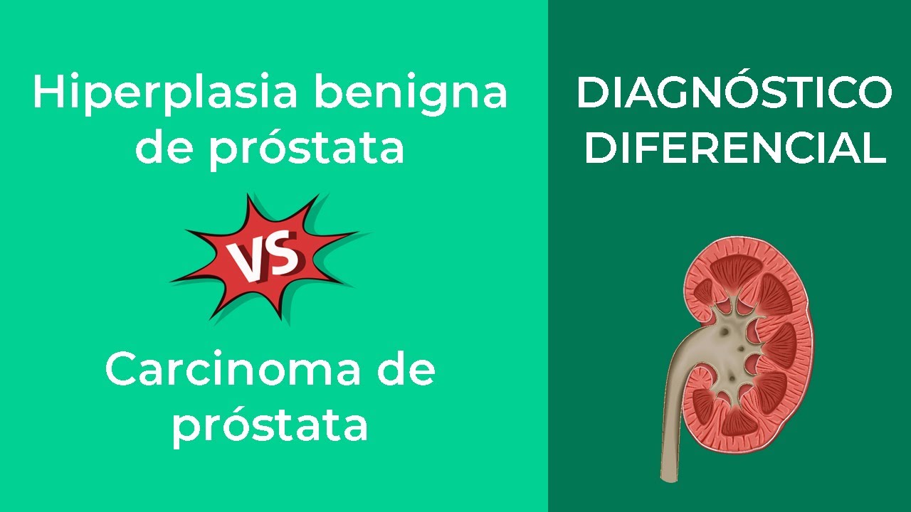 Hiperplasia benigna de próstata vs Carcinoma de próstata. Diagnóstico Diferencial