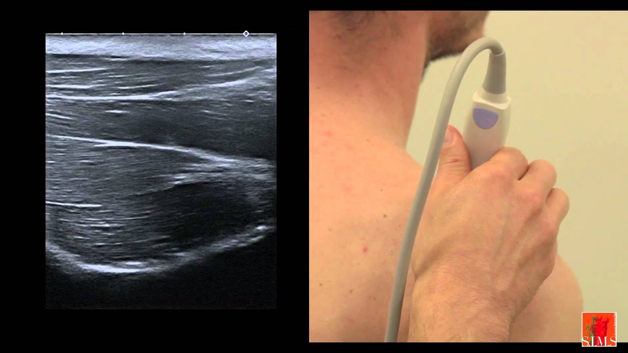 ultrasound of the shoulder III