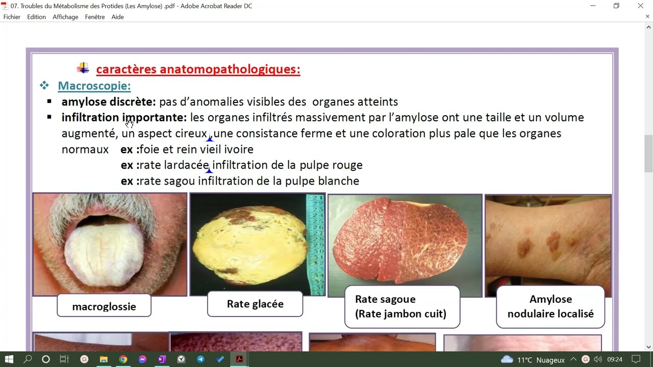 les amyloses (que le nécessaire) AA,AL