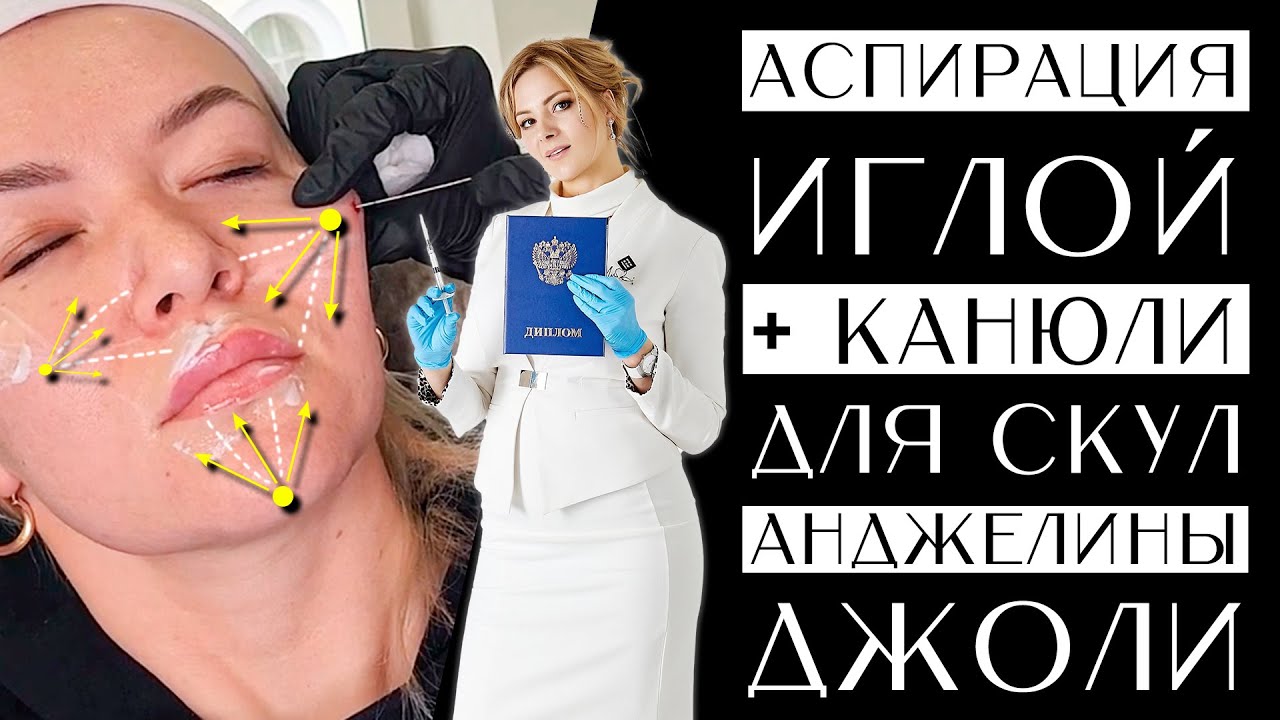Аспирация иглой + канюли для скул Анджелины Джоли