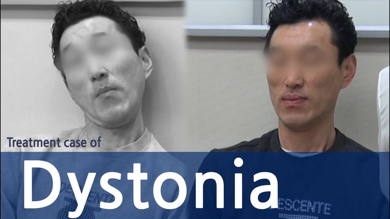 Cervical Dystonia / Dystonia / Spasmodic Torticollis / Dysphonia / 사경증 치료사례 / 근긴장이상증