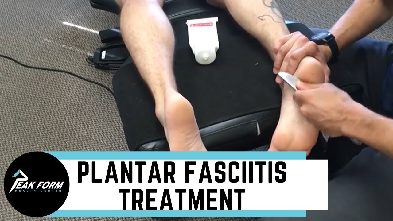 Plantar Fasciitis Treatment in San Diego, What Actually Works for Heel Pain