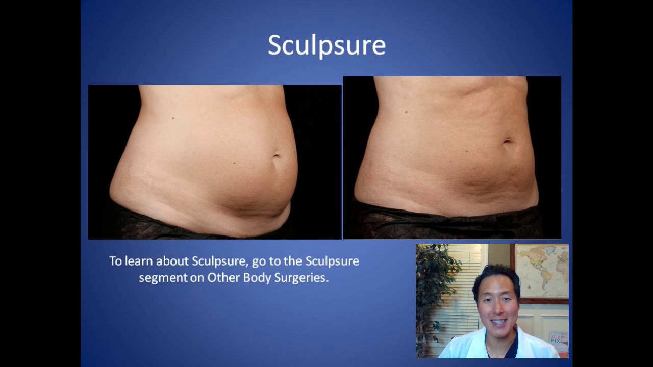 How do I Get Rid of Stubborn Fat - SculpSure and Liposuction Consultation - Dr. Anthony Youn