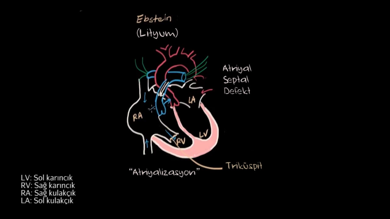 Ebstein Anomalisi (Fen Bilimleri) (Sağlık ve Tıp)