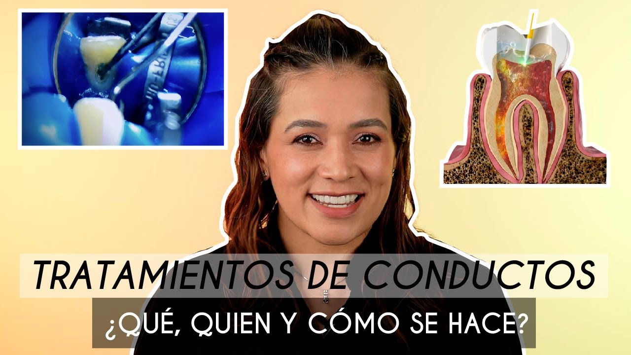 Tratamiento de Conductos 🦷 (Endodoncia) &iquest;Qu&eacute; se hace? 😖 &iquest;Duele? - Odontolog&iacute;a L&aacute;ser.