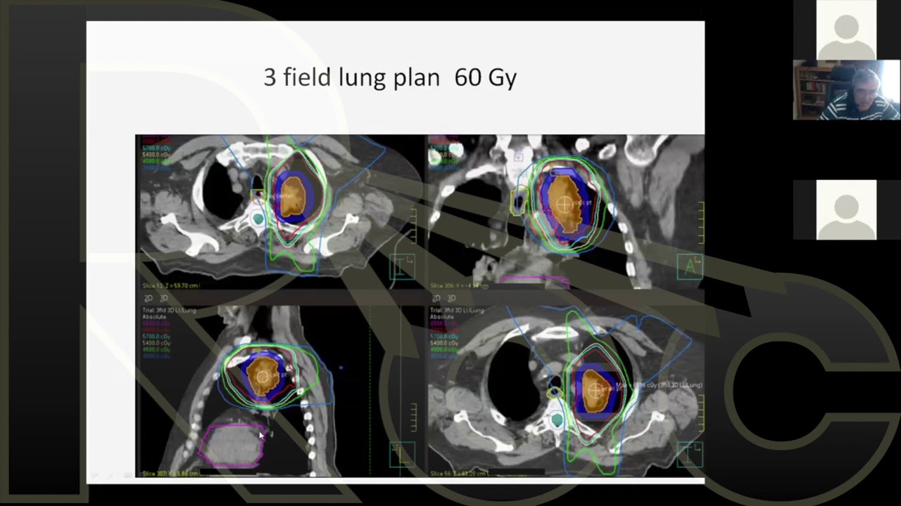2D to 3D EBRT | Session 15 | Evaluating Normal Tissue Constraints and Plans for Treatment