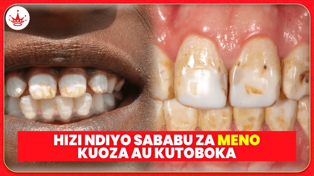 SABABU HIZI ZIMEFANYA WATU WENGI MENO YAO KUOZA NA KUTOBOKA || NA HIVI NDIVYO UNAVYOWEZA KUJITIBU