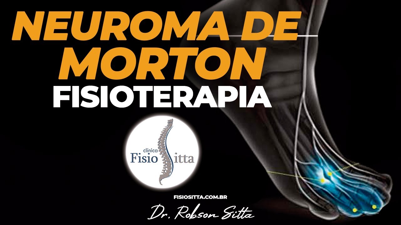 NEUROMA DE MORTON TRATAMENTO TERAPIA MANUAL LASER CROCHETAGEM Clínica Fisioterapia Dr. Robson Sitta