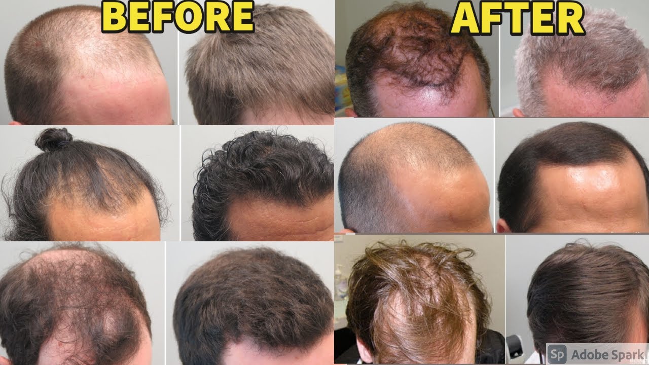BEFORE/AFTER RESULTS OF FINASTERIDE AND MINOXIDIL USERS FOR TREATING HAIR LOSS!