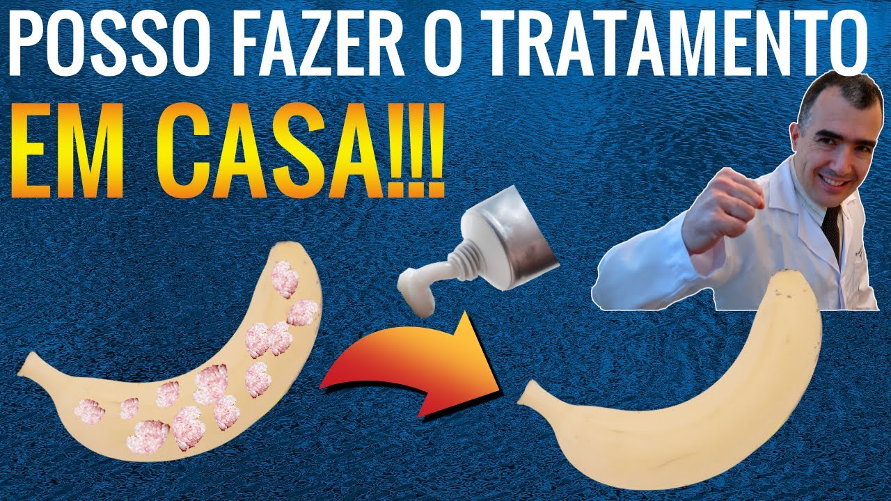 REM&Eacute;DIOS PARA VERRUGAS que voc&ecirc; mesmo pode usar em casa