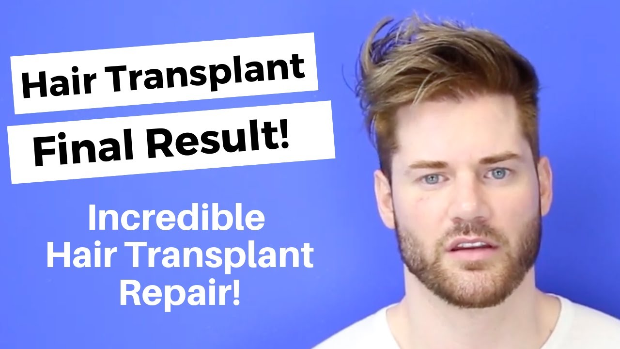 1 Year After Dr. Hasson Repaired This Patient's Previous Surgery From Turkey. SEE HIS FINAL RESULT!