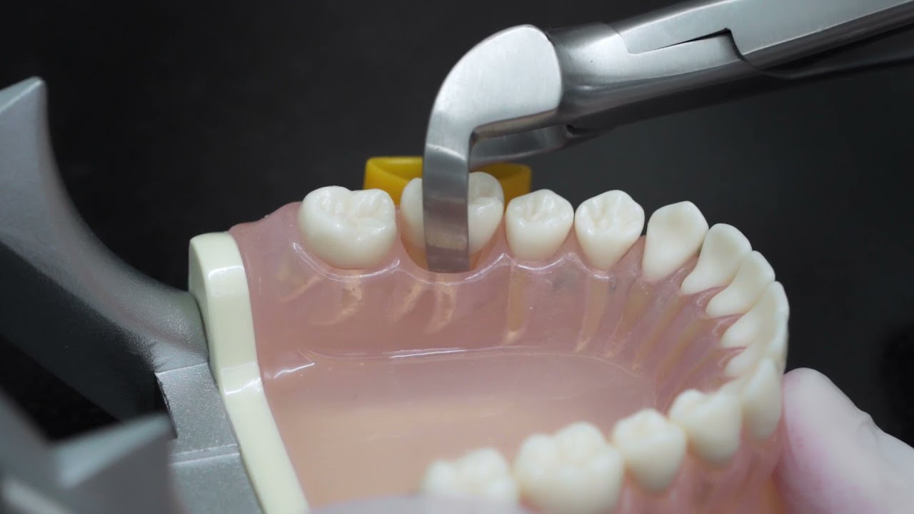 Physics Forceps Atraumatic Extraction System, Tooth Extraction - Dentist Review & Testimonial