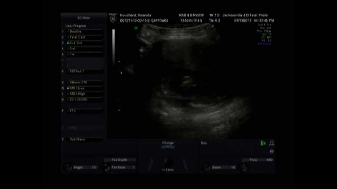 Our Gender Reveal Ultrasound