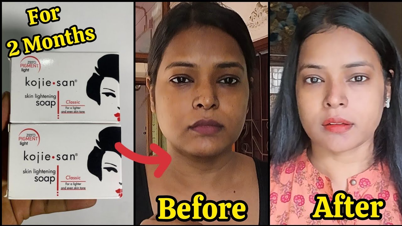 😮OMG I Applied KOJIE SAN SKIN LIGHTENING SOAP For 60 Days | Kojic Acid Soap Real Result Before After