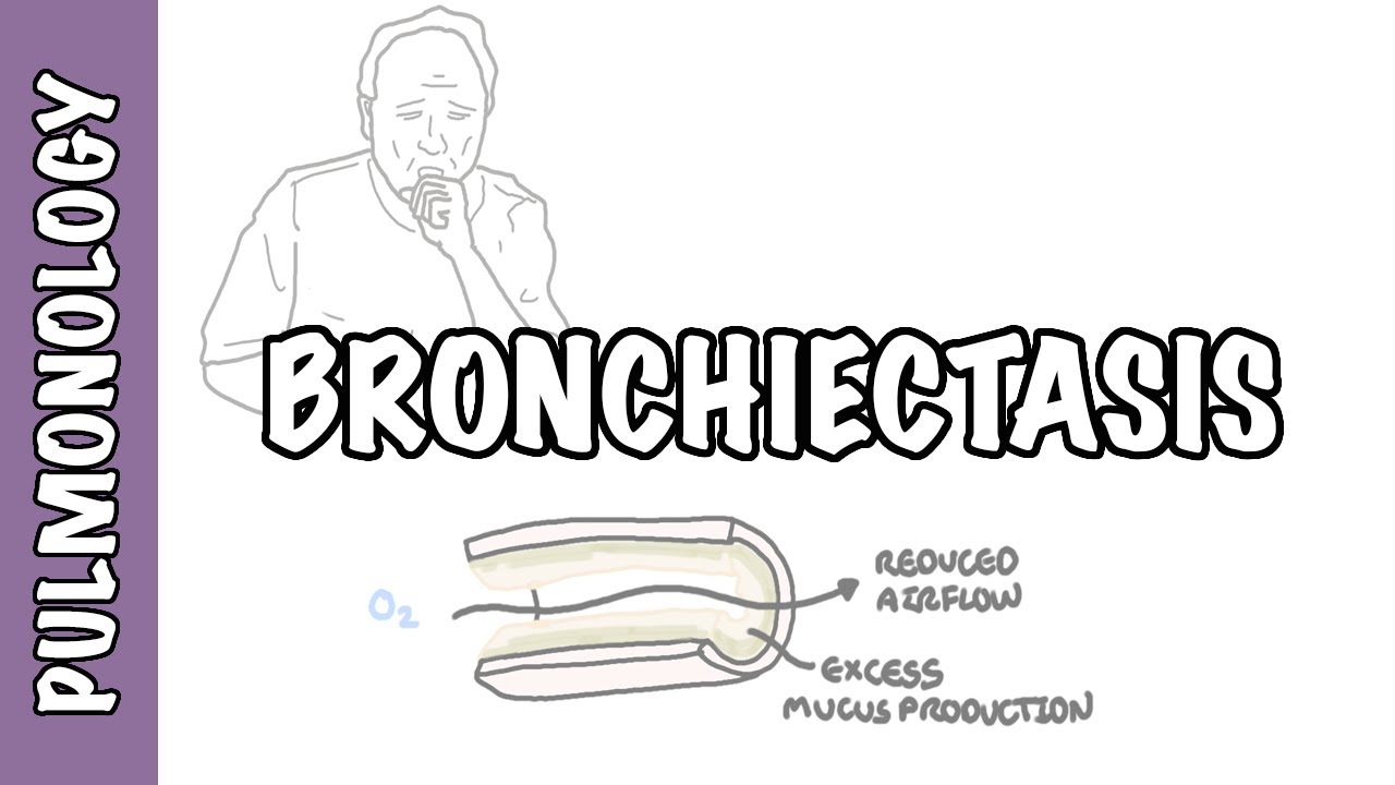 Bronchiectasis - causes, pathophysiology, signs and symptoms, investigations and treatment