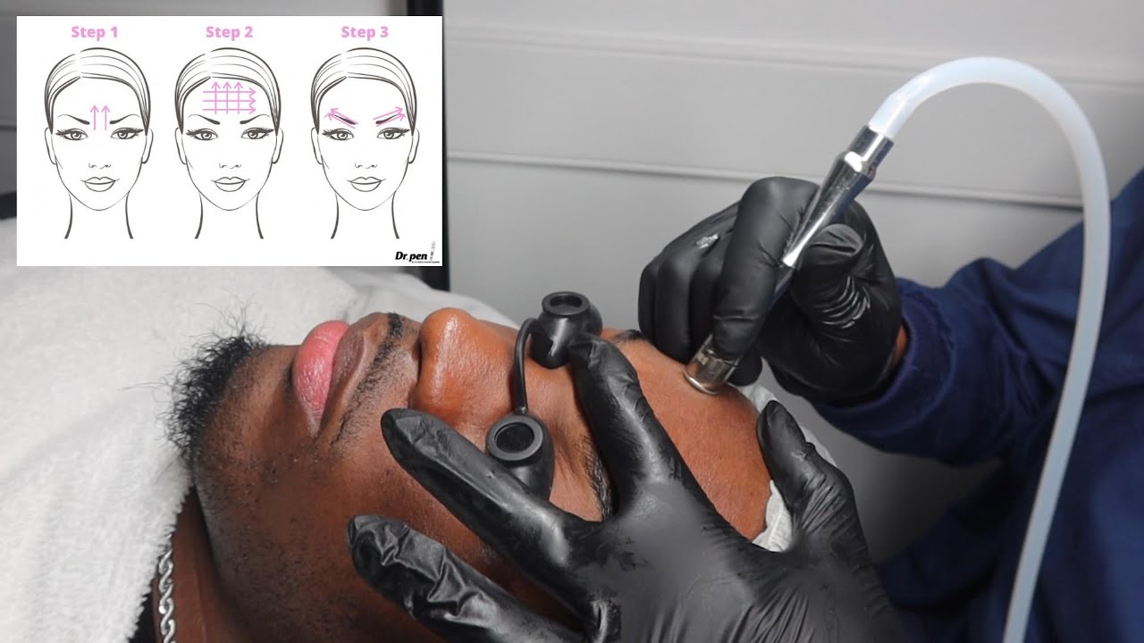 MICRODERMABRASION  FACIAL (STEP BY STEP)