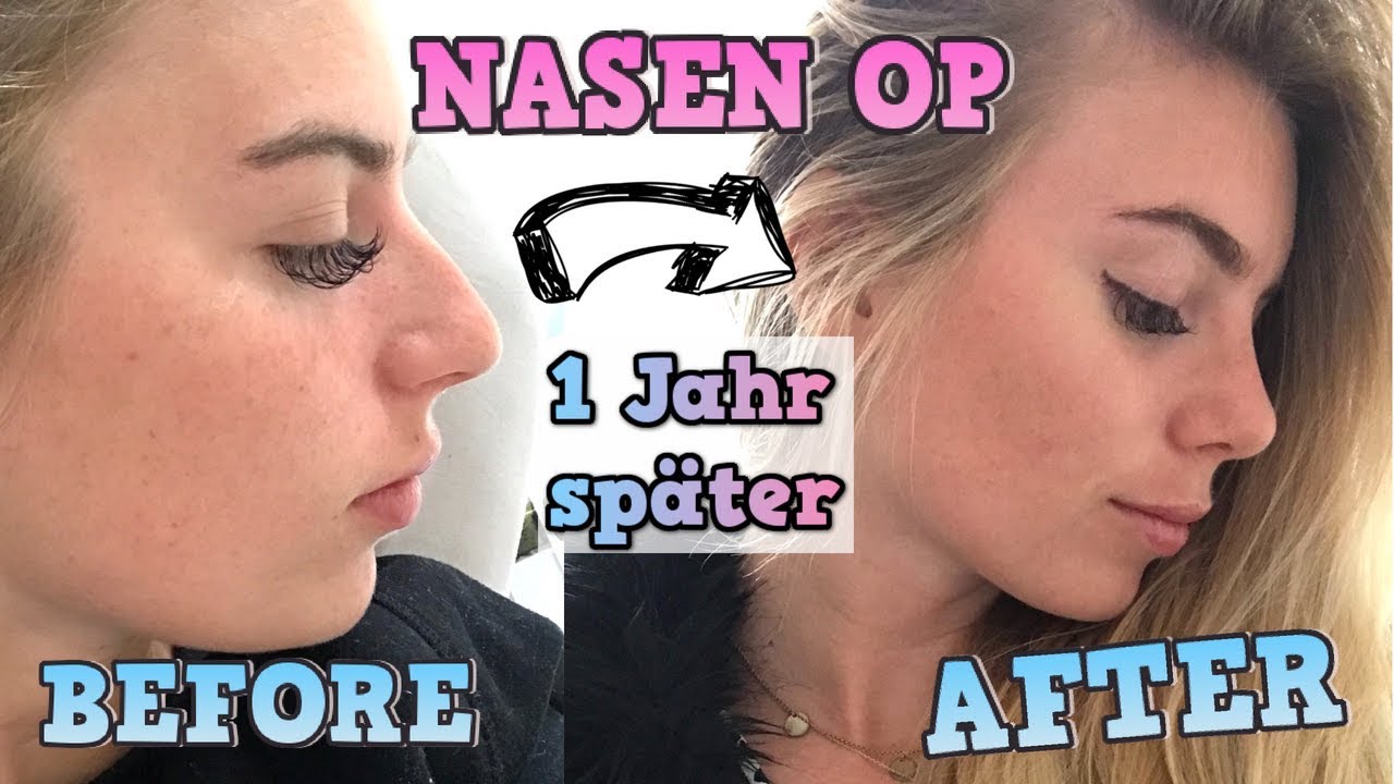 Nasen OP Update I 1 Jahr später I Bereue ich es? Selbstbewusstsein? I ehrliche Meinung