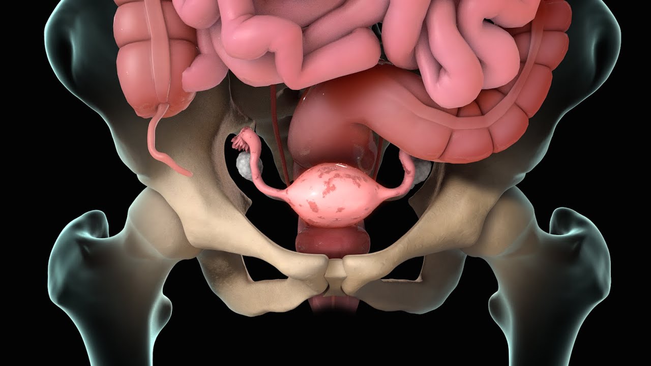 Endometriosis