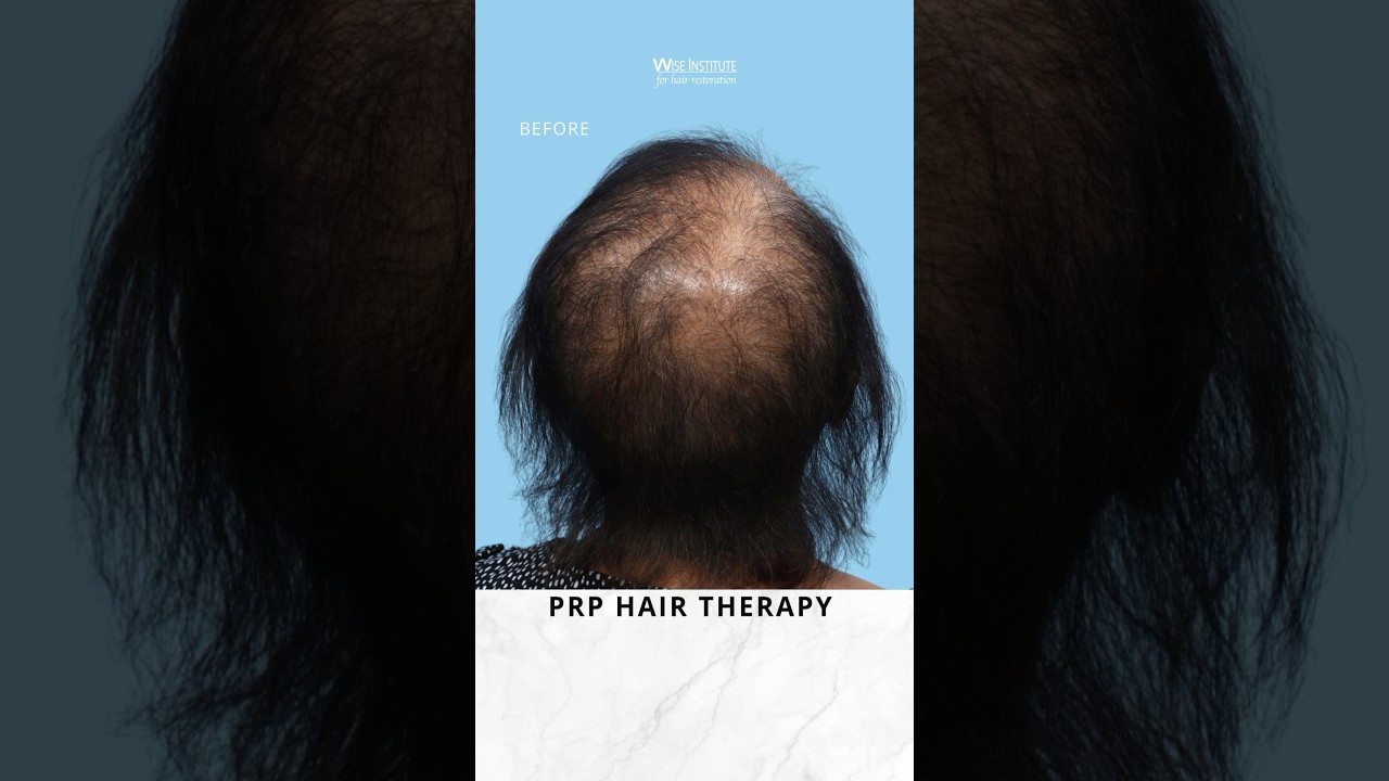 Before and after results: PRP Hair Therapy as a non-surgical female hair loss solution