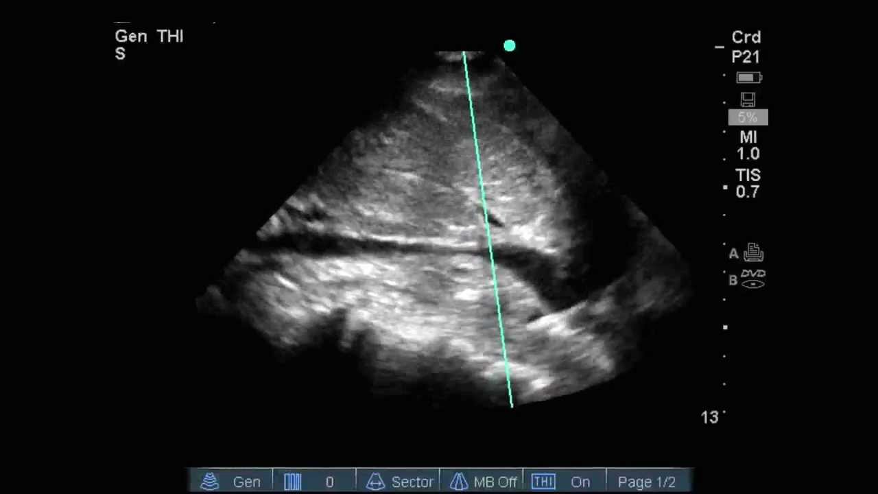 Inferior Vena Cava ultrasound- small and collapsing